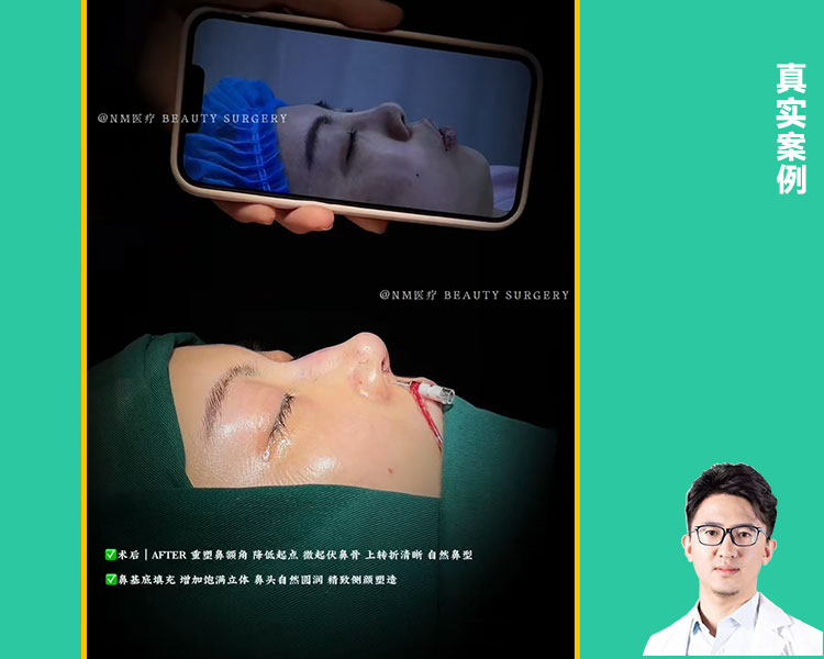 肋骨鼻综合真实案例｜肋软骨塑造自然挺直鼻