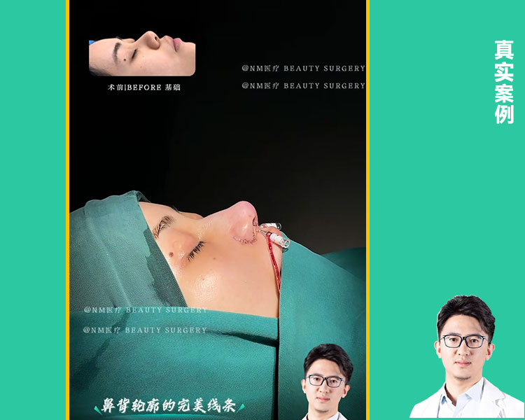复杂鼻修复案例｜挛缩鼻再造·肋软骨重建鼻支架